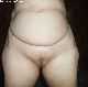 cameltoe